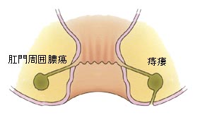 膿瘍 肛門 周囲 肛門周囲膿瘍について